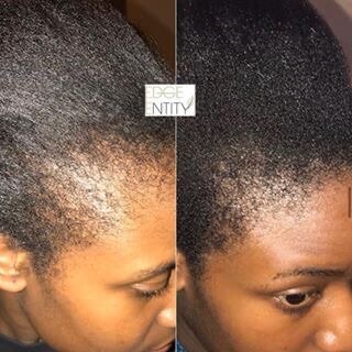 Huile croissance, dermaroller