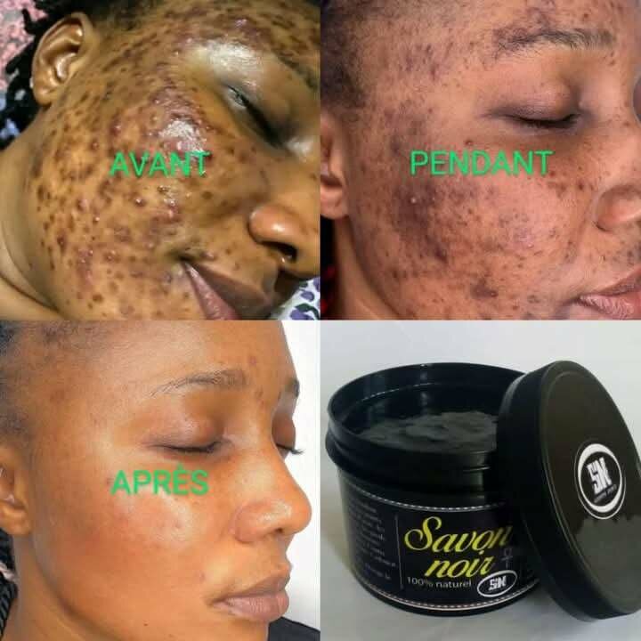 Savon naturel anti-imperfections