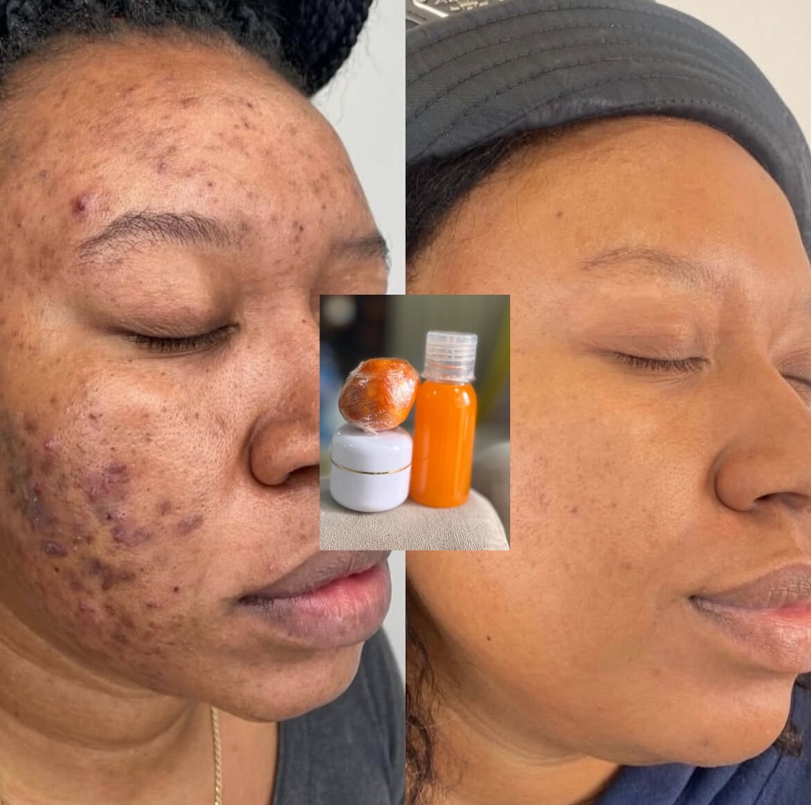 Soin Visage Anti-Acné Naturel