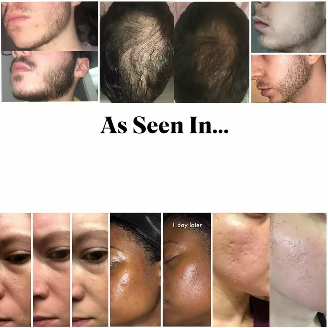 Derma Roller Anti-Âge