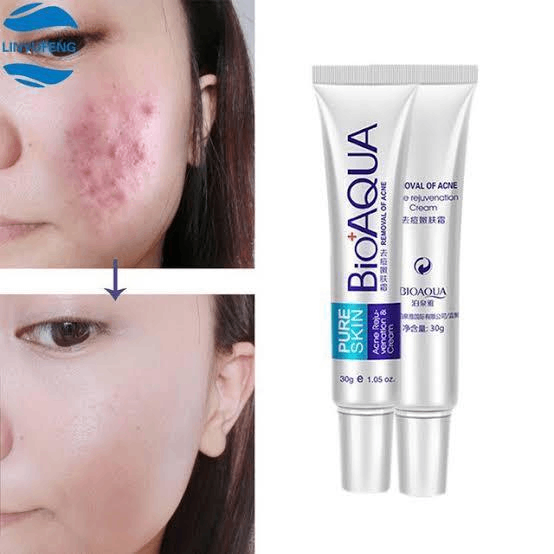 Acne removal cream, 30 g
