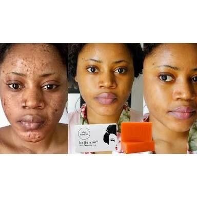 Original Kojic San bar soap for clearing dark spots