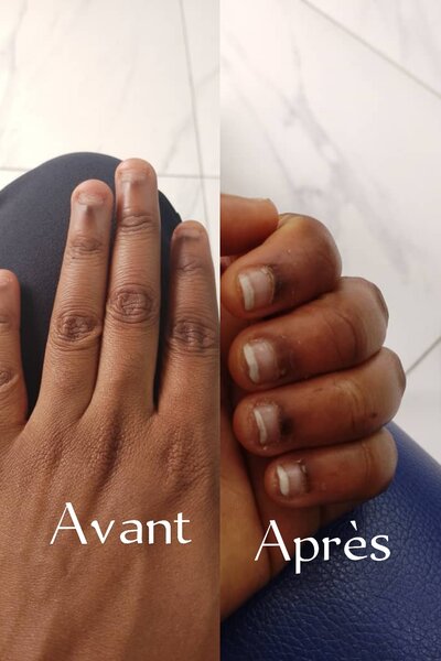 Vernis thérapeutique
