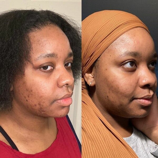 PIMPLES AND DARK SPOTS