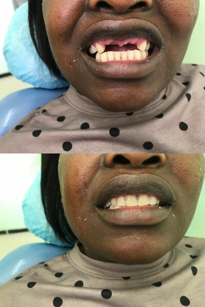 Removable dentures