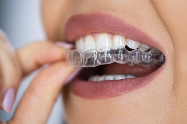 Invisalign aligners