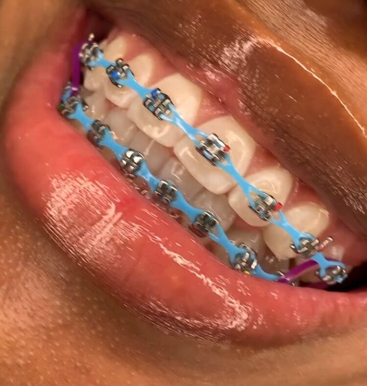 Appareils dentaire fake