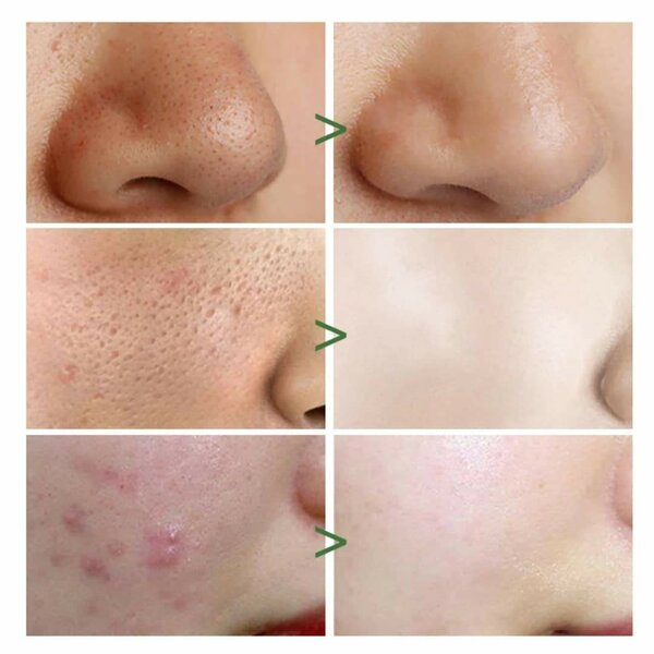 Stick Masque Vert Anti-Peaux