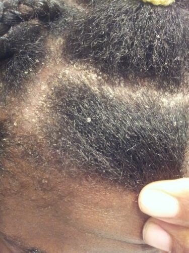 Crème pour cuir chevelu irrité