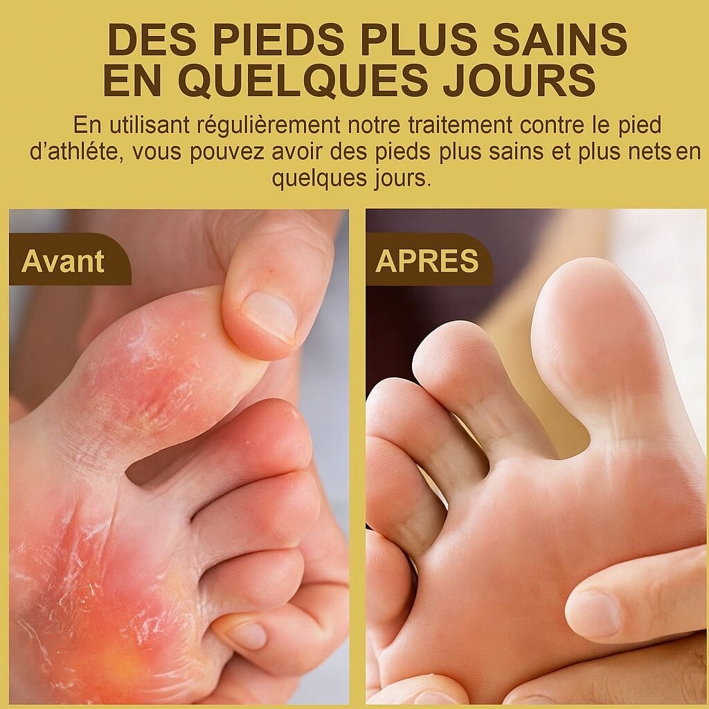Crème antifongique pied efficace