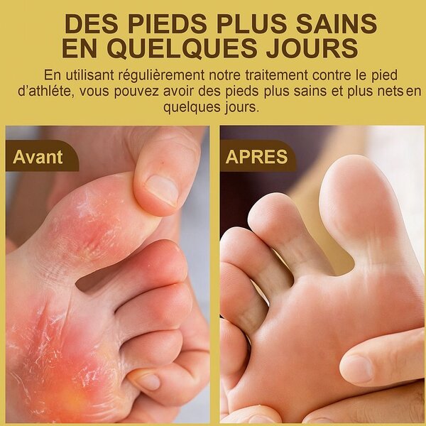 Crème antifongique pied efficace