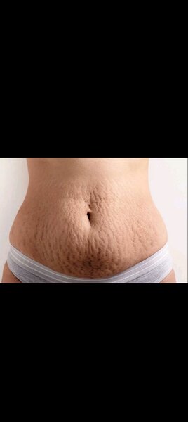 Huile pour vergetures