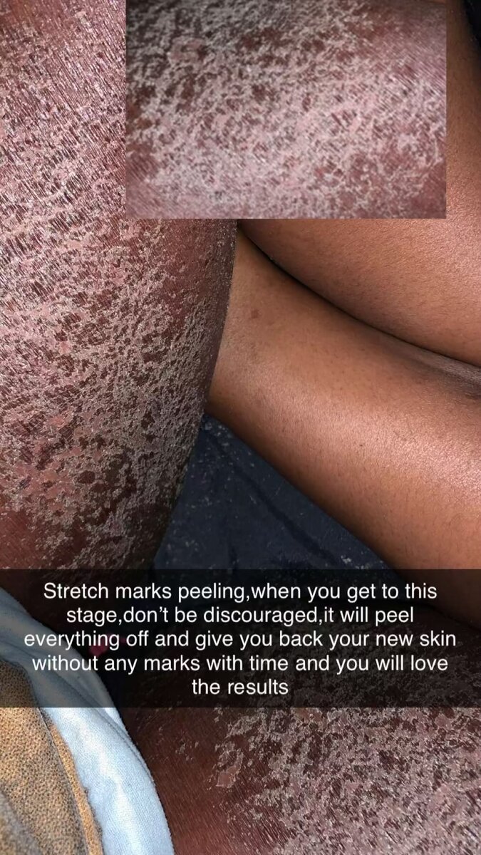 Stretch marks soap