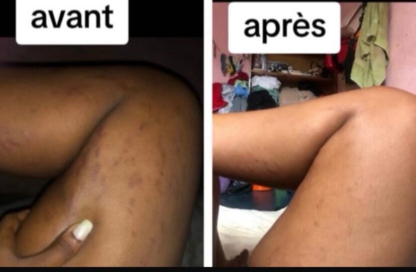 Savon  de vergetures