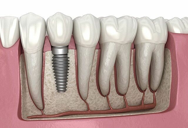 Tooth implant