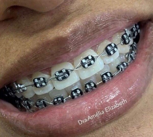 Appareils Dentaires Colorés