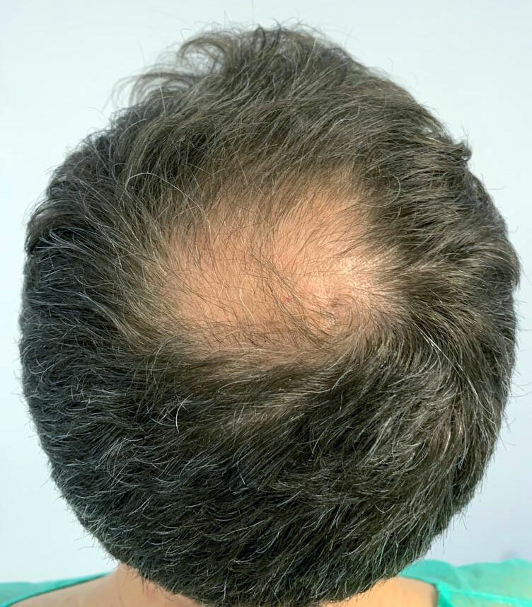 Kit Anti-Alopécie Complet