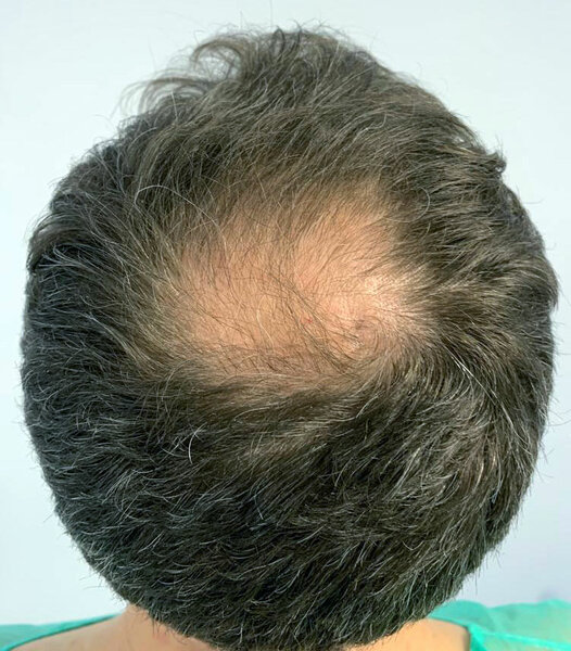 Kit Anti-Alopécie Complet