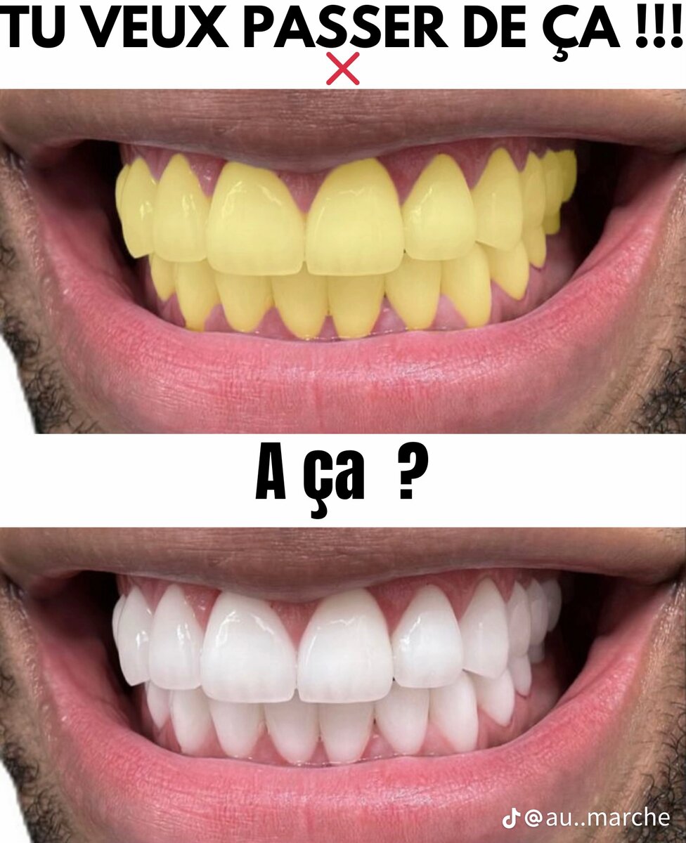 blanchissement dentaire