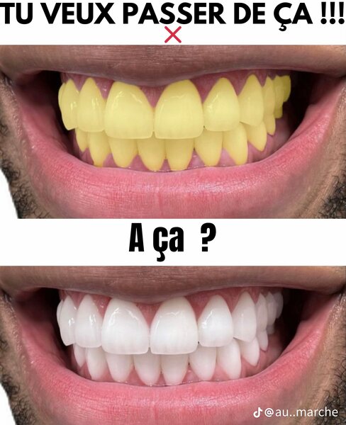 blanchissement dentaire