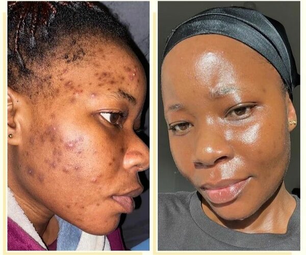 Lotion visage purifiante