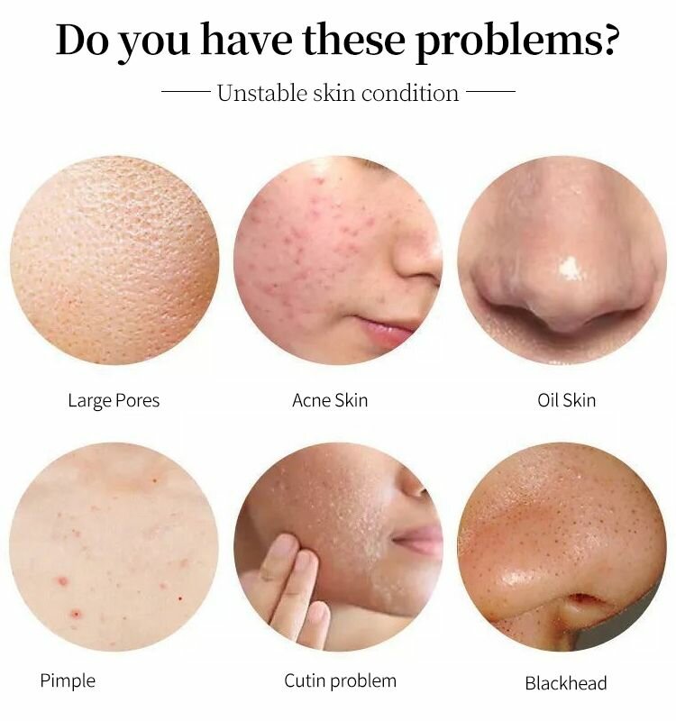 Mask anti-acné