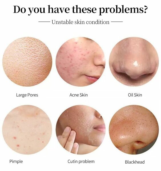 Mask anti-acné