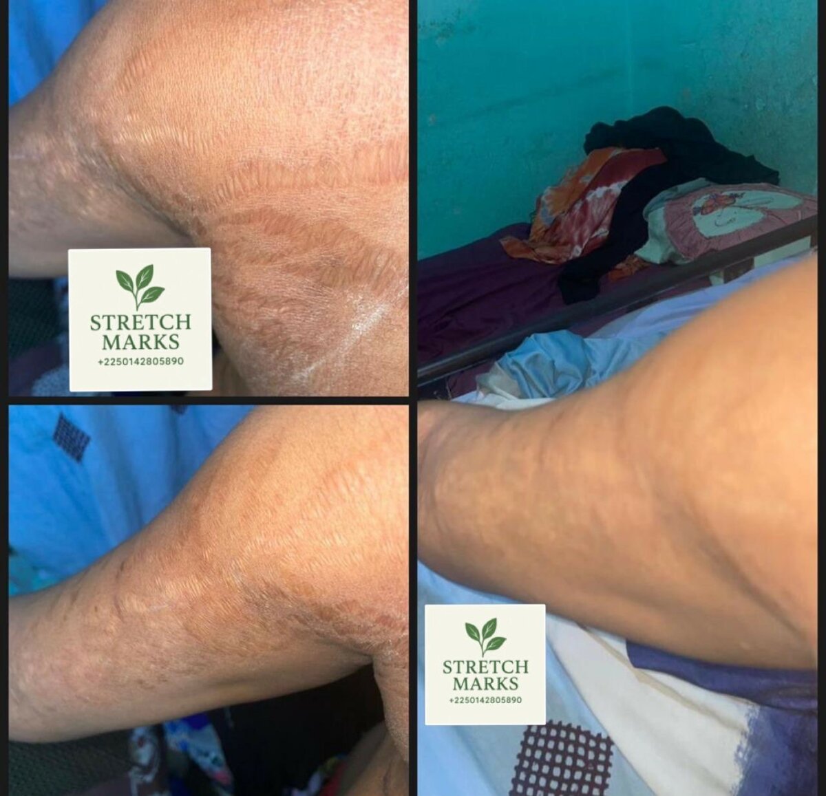 Stretch marks ( vergetures )