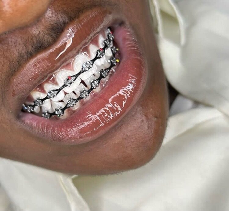 Appareils dentaire fake