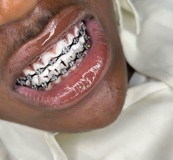 Appareils dentaire fake