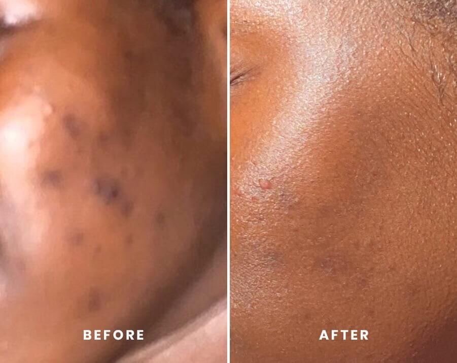 Nettoyant Visage Anti-Acné Tomate 100ml