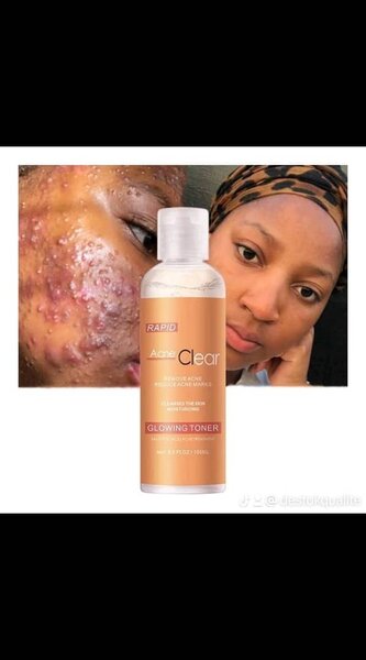 Toner Anti-Acné Éclatant