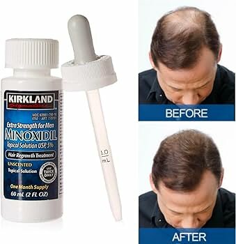 Minoxidil 5% et Derma Roller