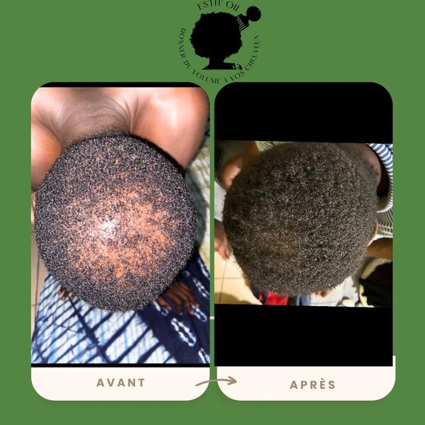 Huile de Croissance Capillaire