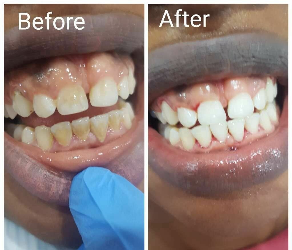 Professional teeth cleaning