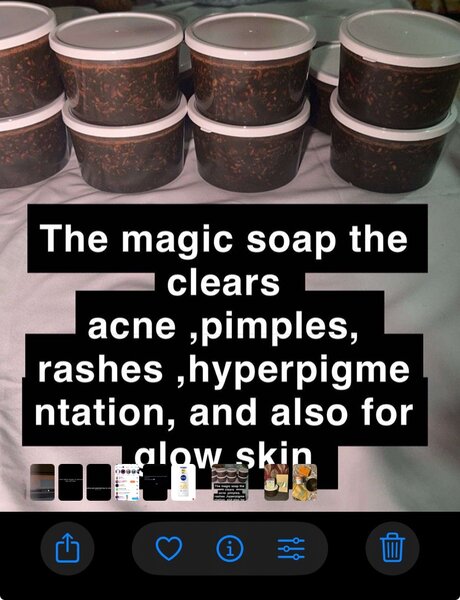 Acne treatment set  (magic black soap)