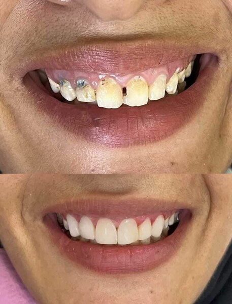Professional teeth whitening