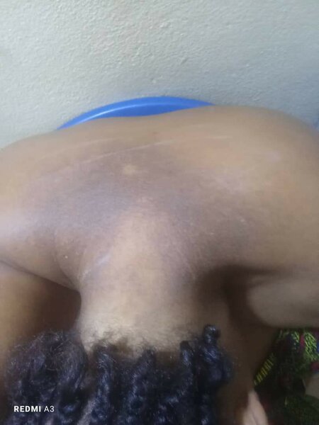 Pack traitement depigmentation professionnelle