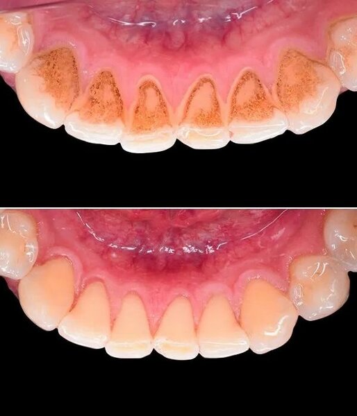 Professional teeth cleaning