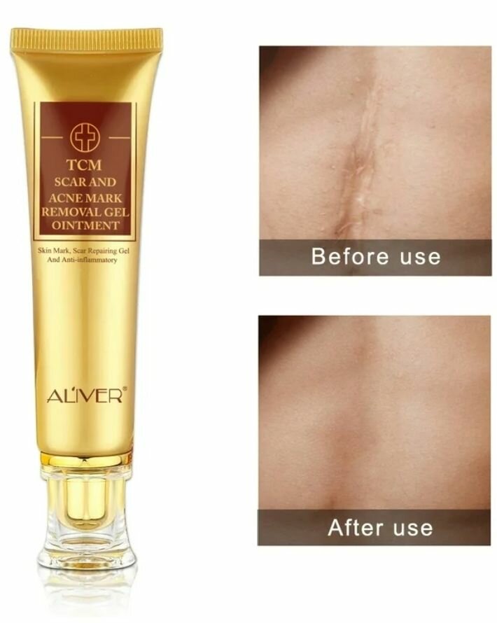 Acné brûlures, vergetures