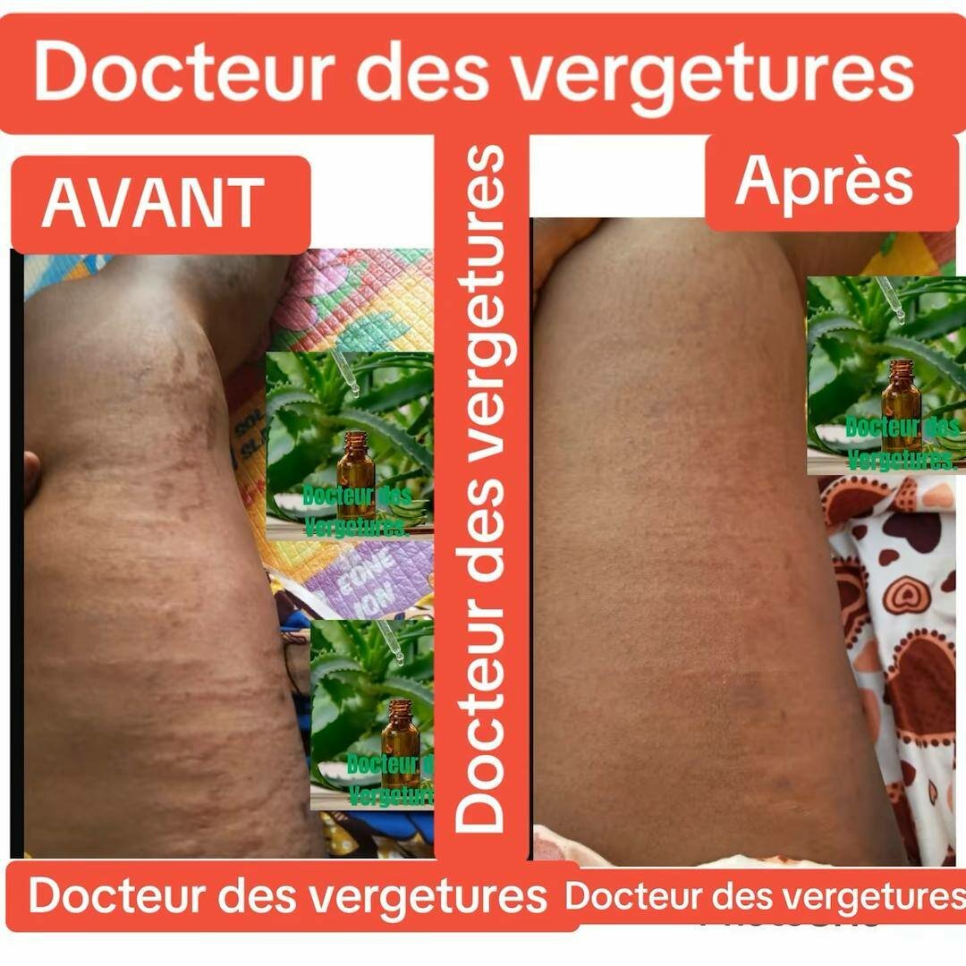Docteur des vergetures