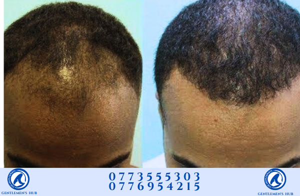 ORIGINAL MINOXIDIL 5% (men & women )