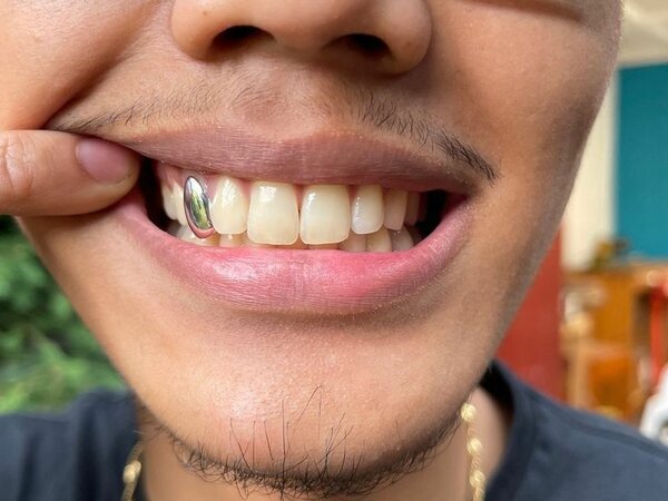 Single grill (tooth grill)