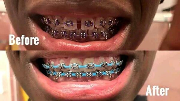Braces
