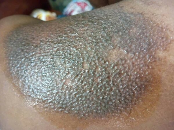 Pack traitement depigmentation professionnelle