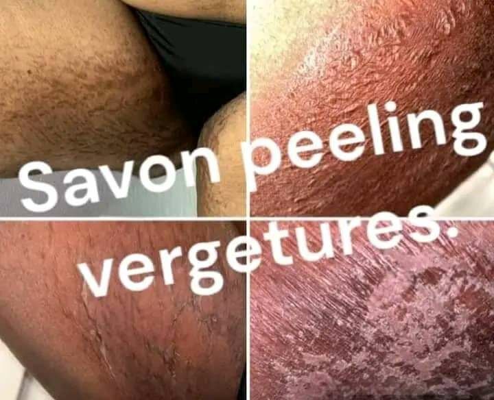 Lotion peeling quinto tâches noires