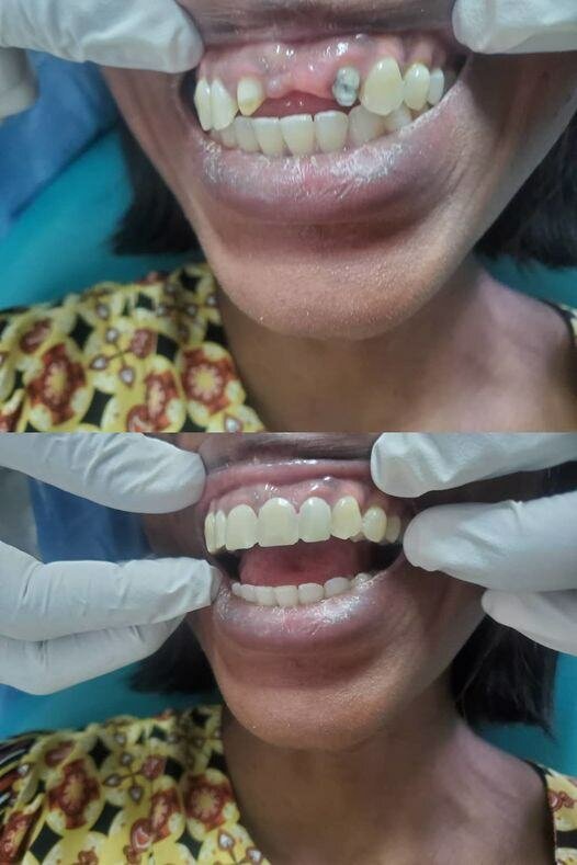 Acrylic tooth crown
