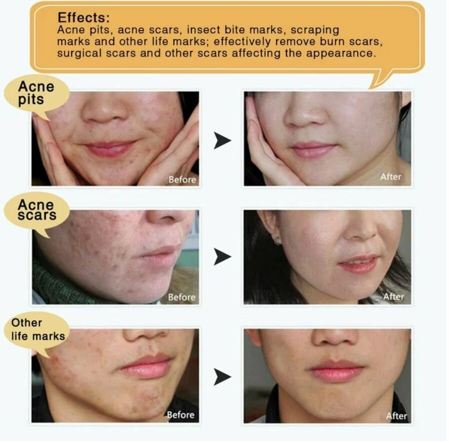 Acné brûlures, vergetures