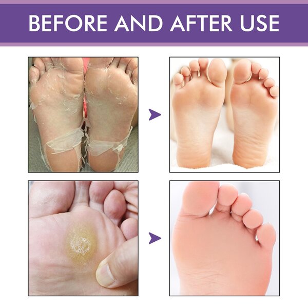 Foot peeling mask