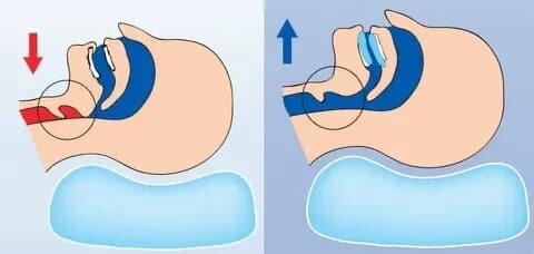 Антихрап Капа от скрипения зубами
